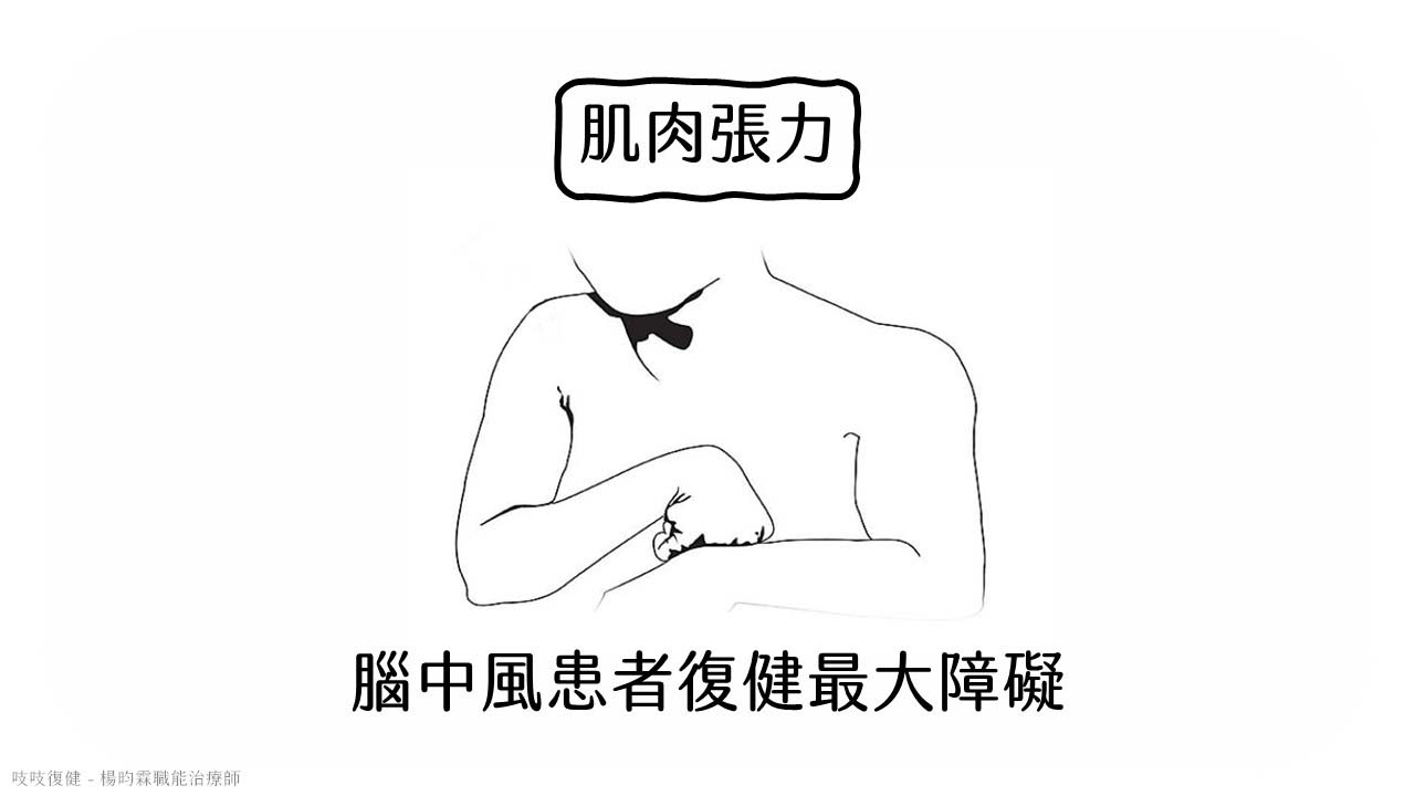 肌肉張力-腦中風復健的最大障礙