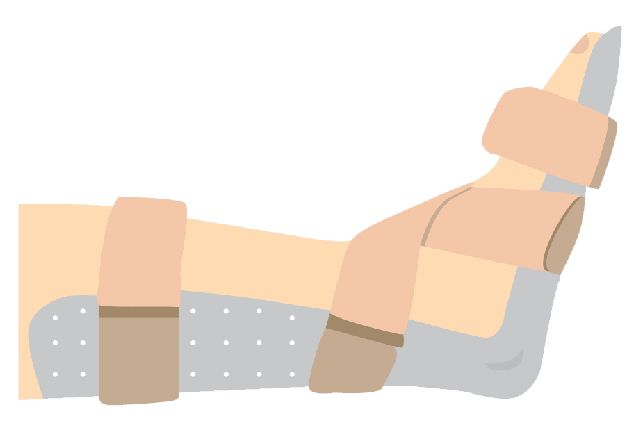 足托板(posterior AFO)